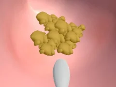 Igra Earwax Clinic online